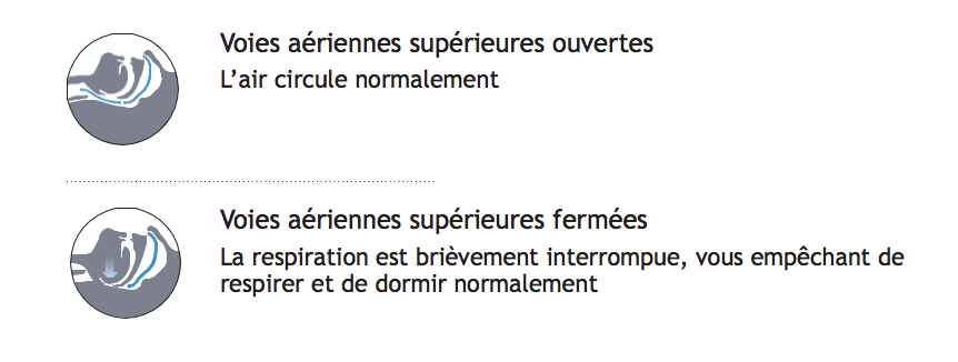Apnée du Sommeil