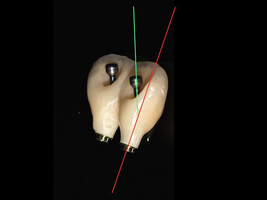 Photo 2 : Procera Implant Bridge zircone HTML CC avec rattrapage de 25 degrés. Travaux du laboratoire DECHE