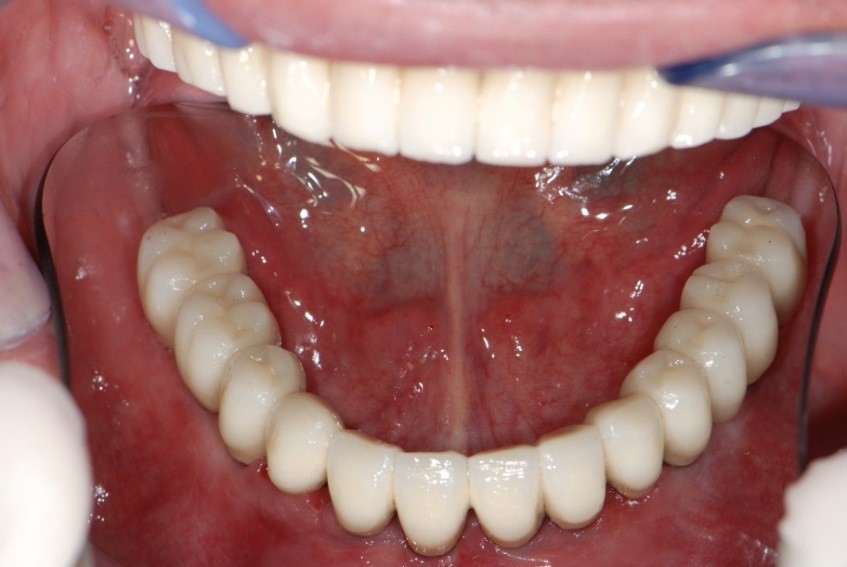 Implants posés de façon parallèle pour permettre une réalisation prothétique scellée.