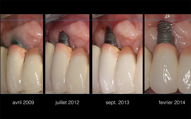 Fig 16: un implant trop vestibulaire que nous avons tenté de faire durer grace à une belle greffe épithélio-conjonctive… la prévisibilité de l’échec l’emporte. La dépose de cet implant le jour même de sa mise en place aurait évité bien des tracas à tout le monde….