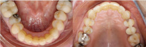 Figure 11bis