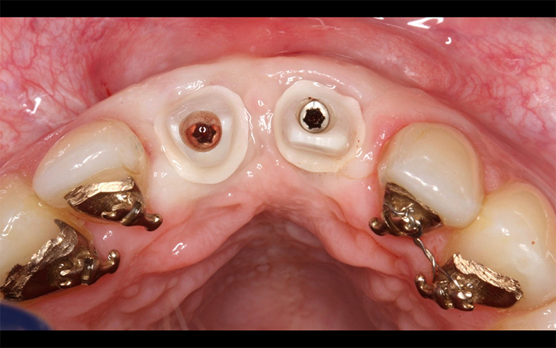 Fig 1: Piliers Zircones anatomiques pour couronnes scellées.