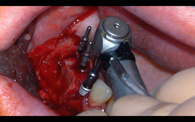 Fig 14 : Nous laissons le maximum d’informations 3D pour la mise en place des implants. Placer l’implant le plus simple d’abord.