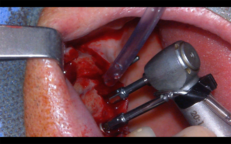 Fig 15: puis laisser un driver dans l’implant initial, ce qui permet de garder ce guidage 3D.