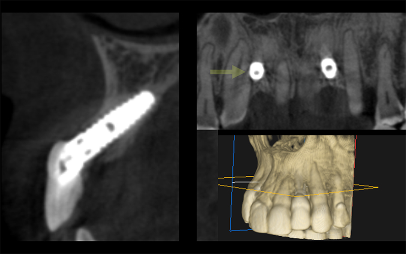 Fig 4, 5: une situation favorable rendue dramatique pour la patiente. Les implants sont parfaitement osteo-intégres, et il n’y a aucun signe de péri-implantite. Mais l’axe a induit un déplacement vertical des tissus, qui a conduit le praticien à l’emploi d’une fausse gencive. 