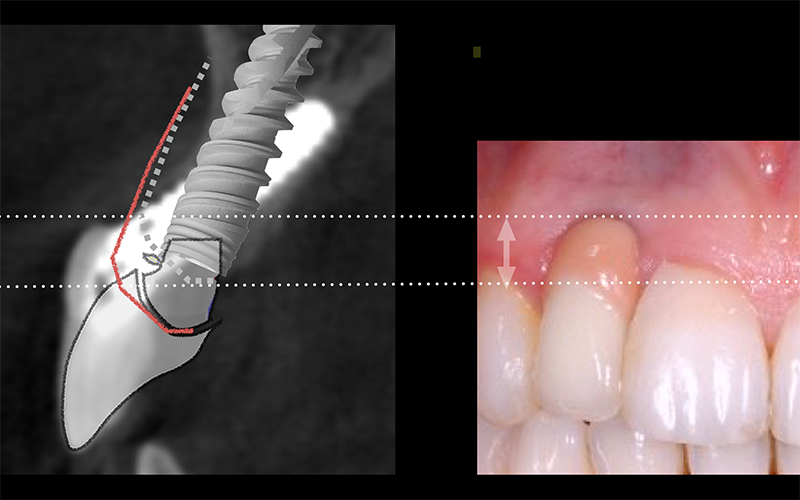 Fig 4, 5 : Une situation favorable rendue dramatique pour la patiente. Les implants sont parfaitement osteo-intégres, et il n’y a aucun signe de péri-implantite. Mais l’axe a induit un déplacement vertical des tissus, qui a conduit le praticien à l’emploi d’une fausse gencive.