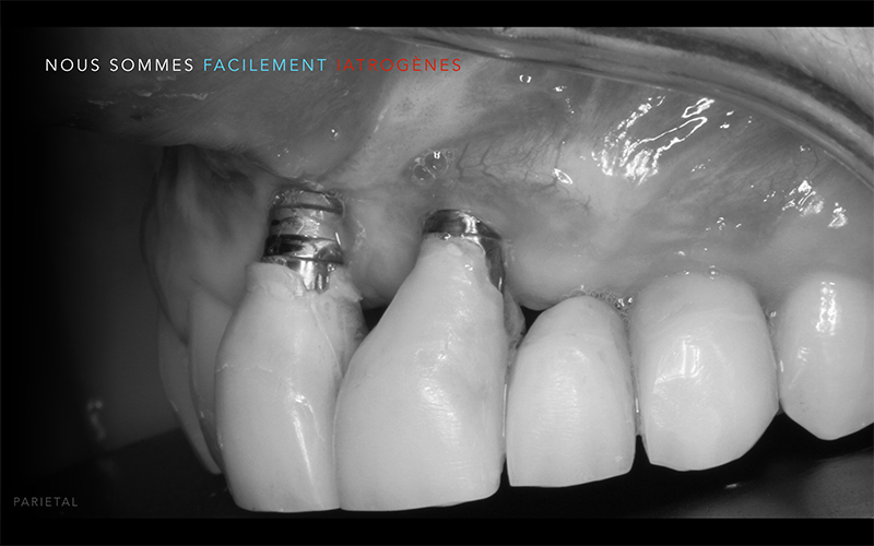 Fig 6: échec esthétique majeur par positionnement trop vestibulaire et trop angulé des implants. 