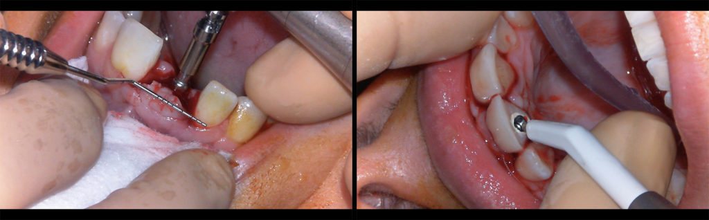 Fig 9 et 10