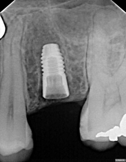 Figure 10 : Radiographie rétroalvéolaire post-opératoire