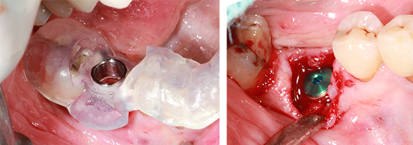 Fig 3 : L’utilisation d’un guide chirurgical facilite grandement la mise en place et le maintien d’un axe correct lors du vissage