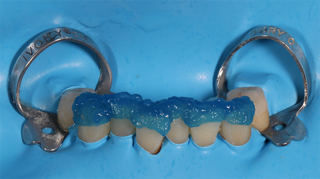 Fig. 11 : Mordançage avant stratification des composites à main levée