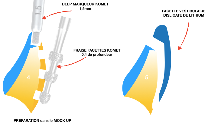 Fig. 13 : Préparation des dents antérieures après mise en place du nouveau mock-up