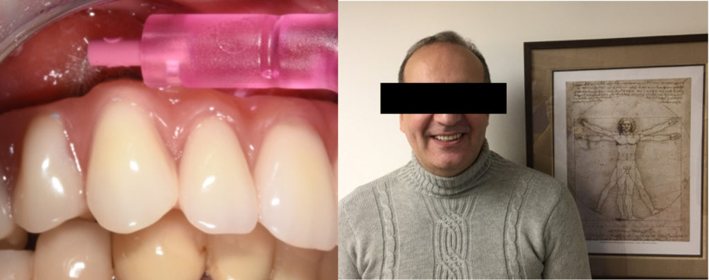 Fig 11 : Cas clinique 1 : accessibilité aux brossettes, sourire final