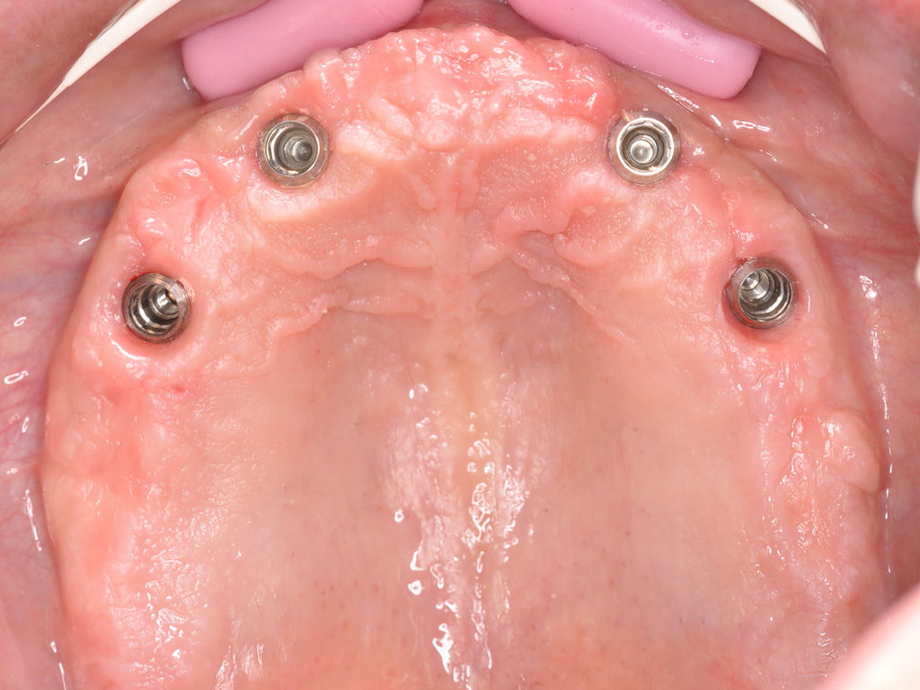 Contrôle de l’environnement gingival à 6 mois