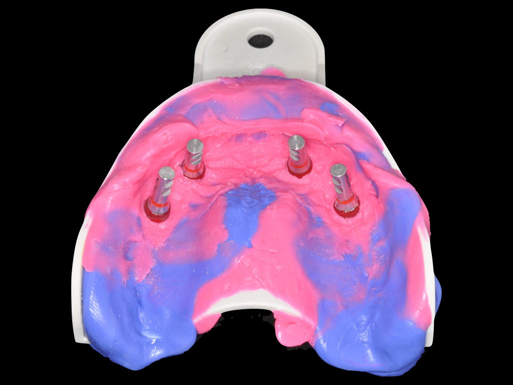 Empreinte et positionnement des analogues (Zermack Hydrorise implant)