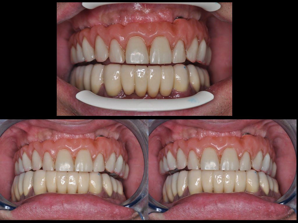 Contrôle de l’occlusion à 1an avec une mastication unilatérale alternée