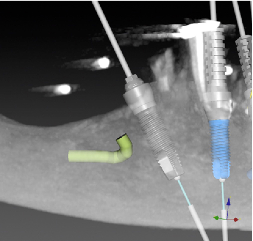Fig 4 : Présence d'une boucle antérieure tracée sur logiciel de planification (dtx studio)