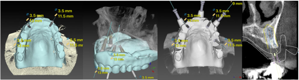 Fig 6 : Cas clinique 1 : double scanner, planification (dtx studio) et guide pilot