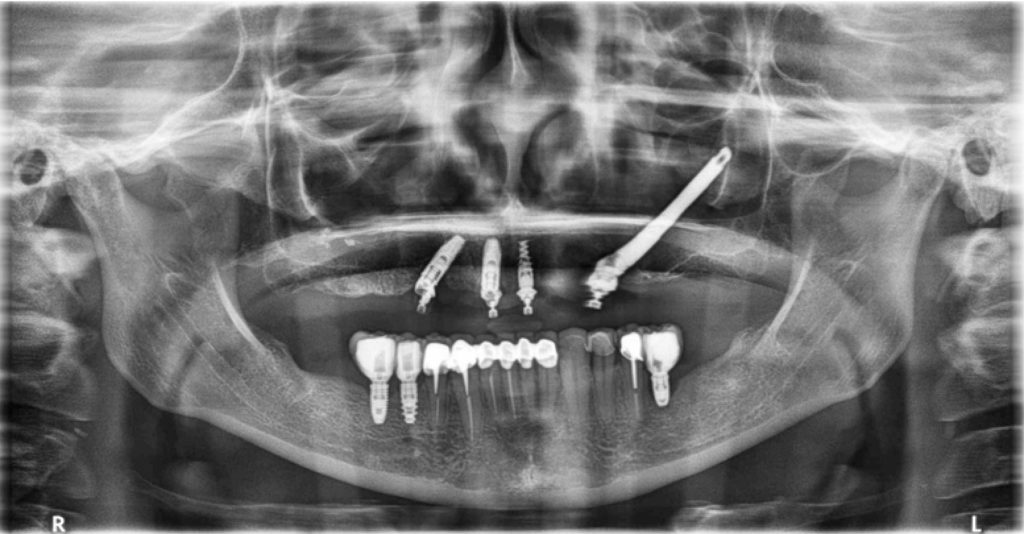 Fig 7 : Cas clinique 2 : Rescue implant : rattrapage d'un implant distal non ostéointégré sur ALL-ON-4 par un implant zygomatique