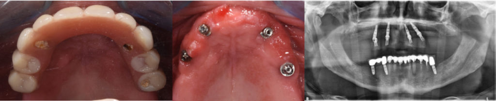 Fig 9 : Cas clinique 1 : Bridge provisoire placé en mise en charge immédiate