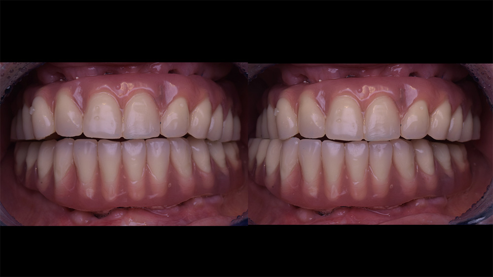 Mastication unilatérale alternée avec 2 bridges posés le jour même dans le cadre d’une MCI avec 2 barres soudées (Laboratoire RUOCCO)
