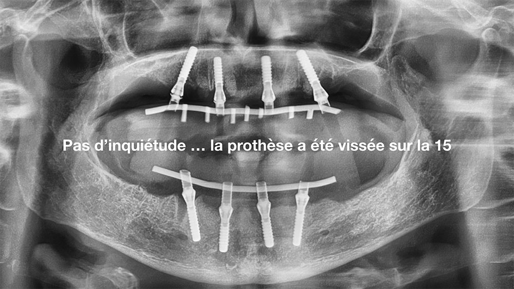 Panoramique de contrôle post op le jour de la chirurgie