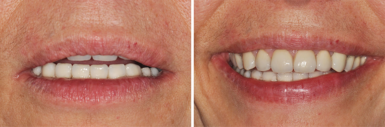 Fig. 12a : Situation finale, lèvres au repos. Fig. 12b : Situation finale lors du sourire.