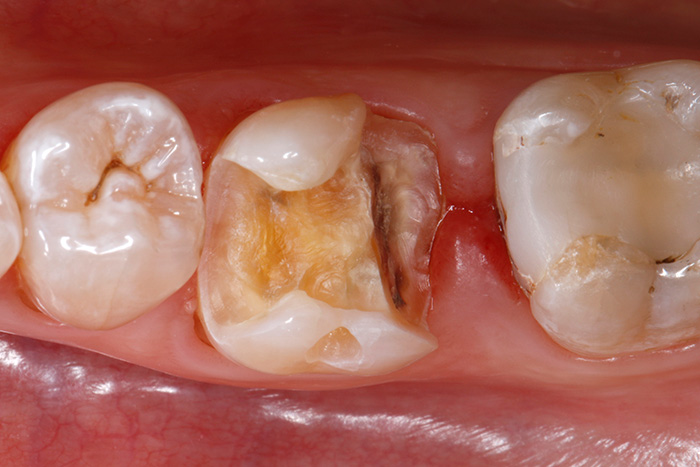 Ill. 2 : Finition de la cavité une fois l'ancienne obturation retirée et les parties cariées de la dent excavées. Au niveau du fond de la cavité distal, la délimitation du défect est nettement sous-gingivale et la cuspide disto-linguale manquante doit être entièrement reconstituée avec du matériau composite.