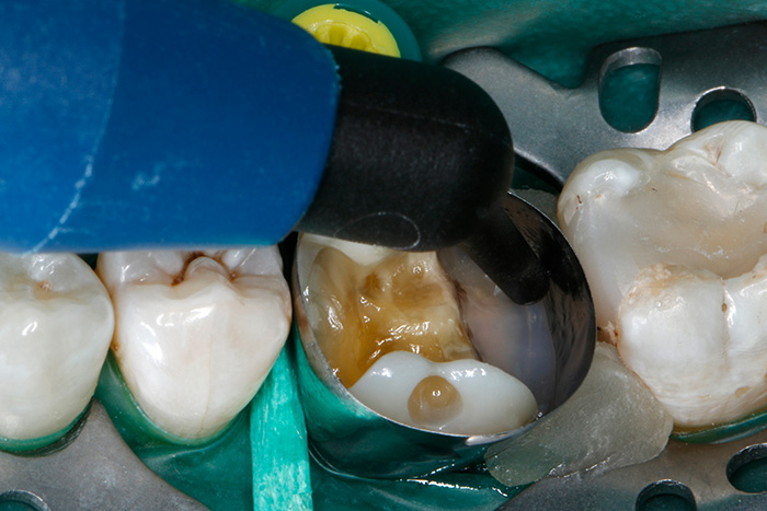 Ill. 12 : Dans une première étape, VisCalor bulk est appliqué en petite quantité uniquement au niveau du fond de la cavité distal.