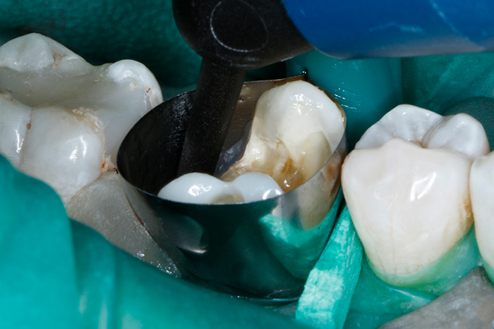 Ill. 16 : La deuxième couche de matériau composite « bulk fill » thermovisqueux VisCalor bulk comble entièrement le reste de la cavité.