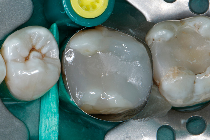 Ill. 17 : La cuspide disto-linguale manquante est entièrement reconstituée en matériau composite. Vient ensuite la photopolymérisation du matériau d'obturation pendant 20 s.