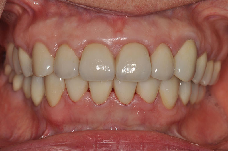 Fig. 11e : Restauration finale, vue frontale en OIM.