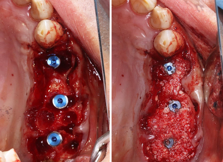 Fig. 06 et 07 : Mise en place des implants.