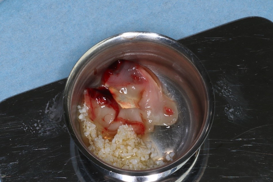 Fig. 07 : Comblement des défauts osseux par un mélange Bio Oss et Aprf