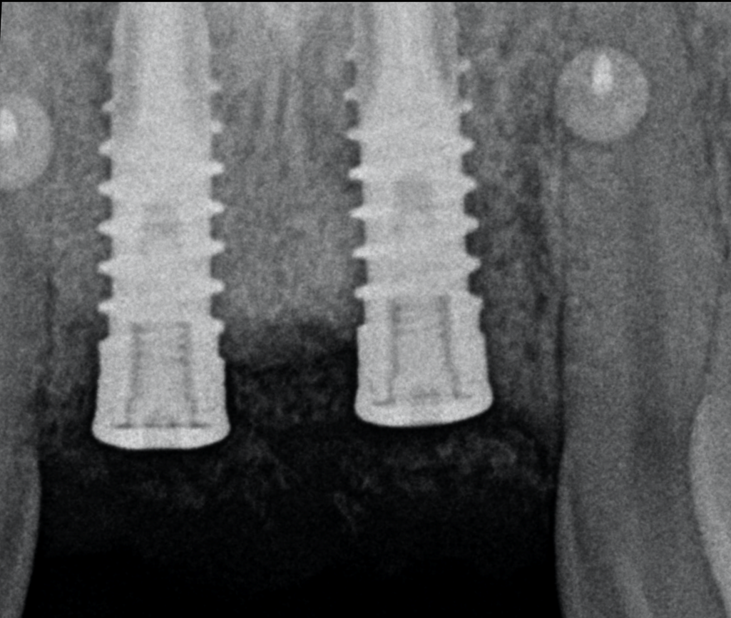 radio post op