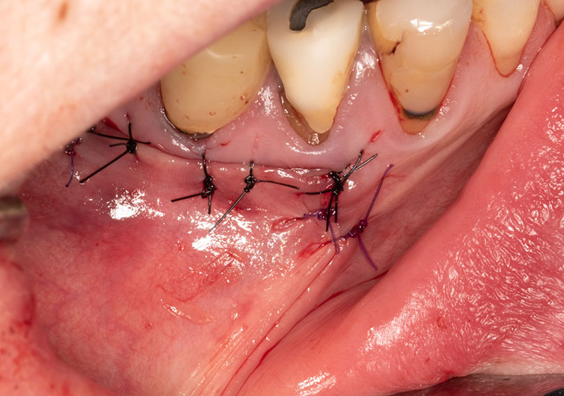 Points de suture