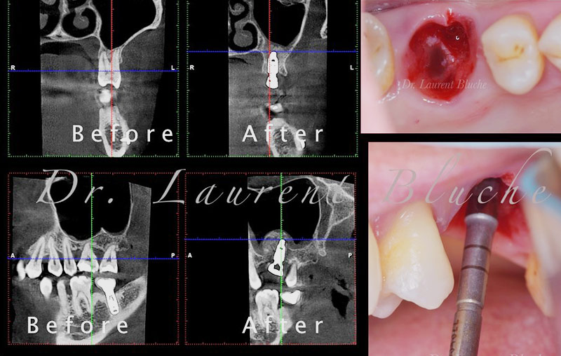 3-Chirurgie-post-extractionnelle-Laurent-Bluche
