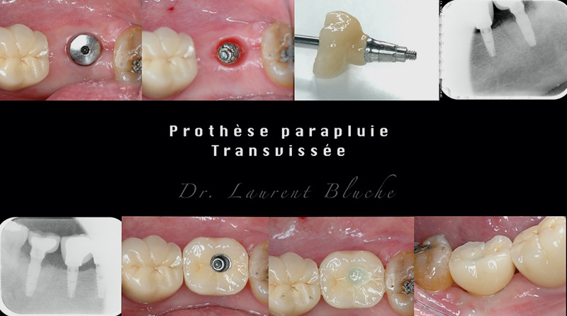 5-Chirurgie-déficit-osseux-Laurent-Bluche