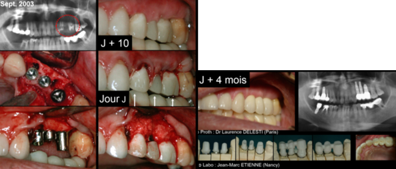 Figure-3-Montage-Abbou