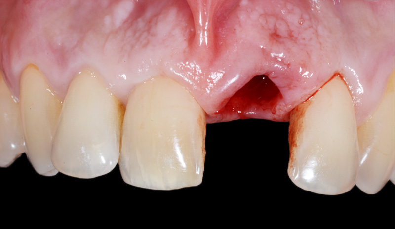 fig03-bisico-teinte