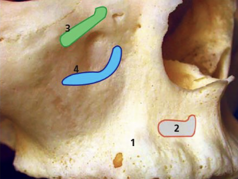 Face antéro-latérale du maxillaire - L’implant osseux à visée esthétique