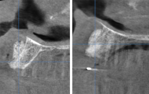 image post-opératoire immédiate - L'Implant Osseux à visée Esthétique