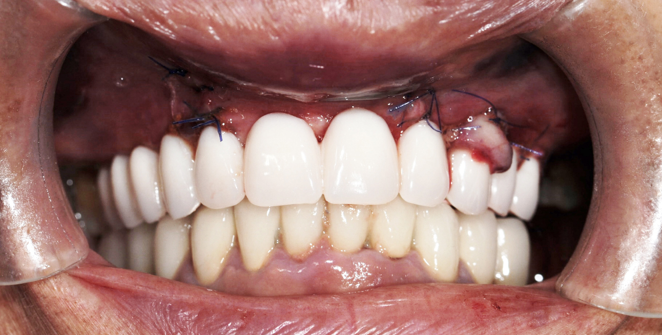 Mise en charge immédiate all on 6 - L'Implant Osseux à visée Esthétique