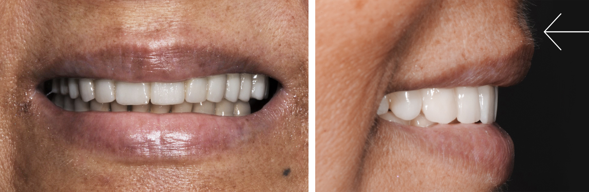 Soutien lèvre supérieure - L'Implant Osseux à visée Esthétique
