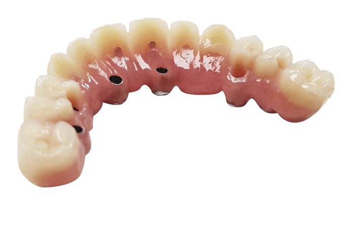 Bridge avec dents résines - L’implant osseux à visée esthétique