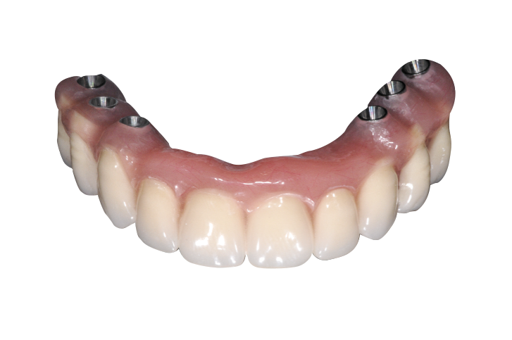 Compensation esthétique - L’implant osseux à visée esthétique