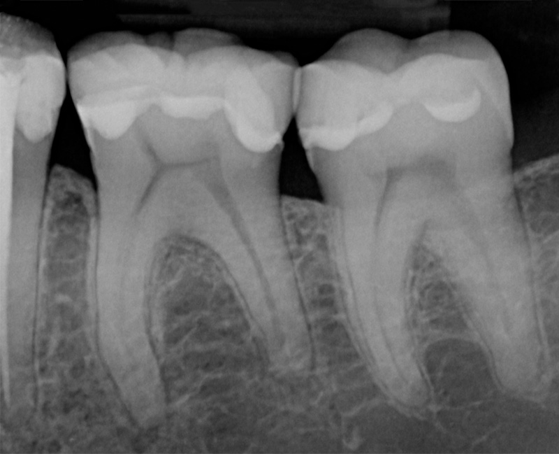 fig01-obturation-academie-sourire-endodontique