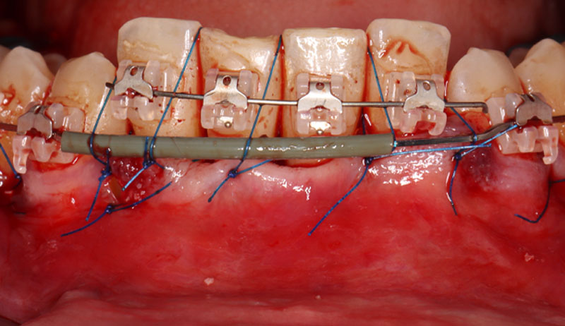 fig05-corticotomie