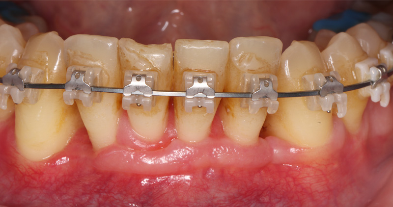fig06-corticotomies
