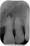 fig-01-endo-guidée